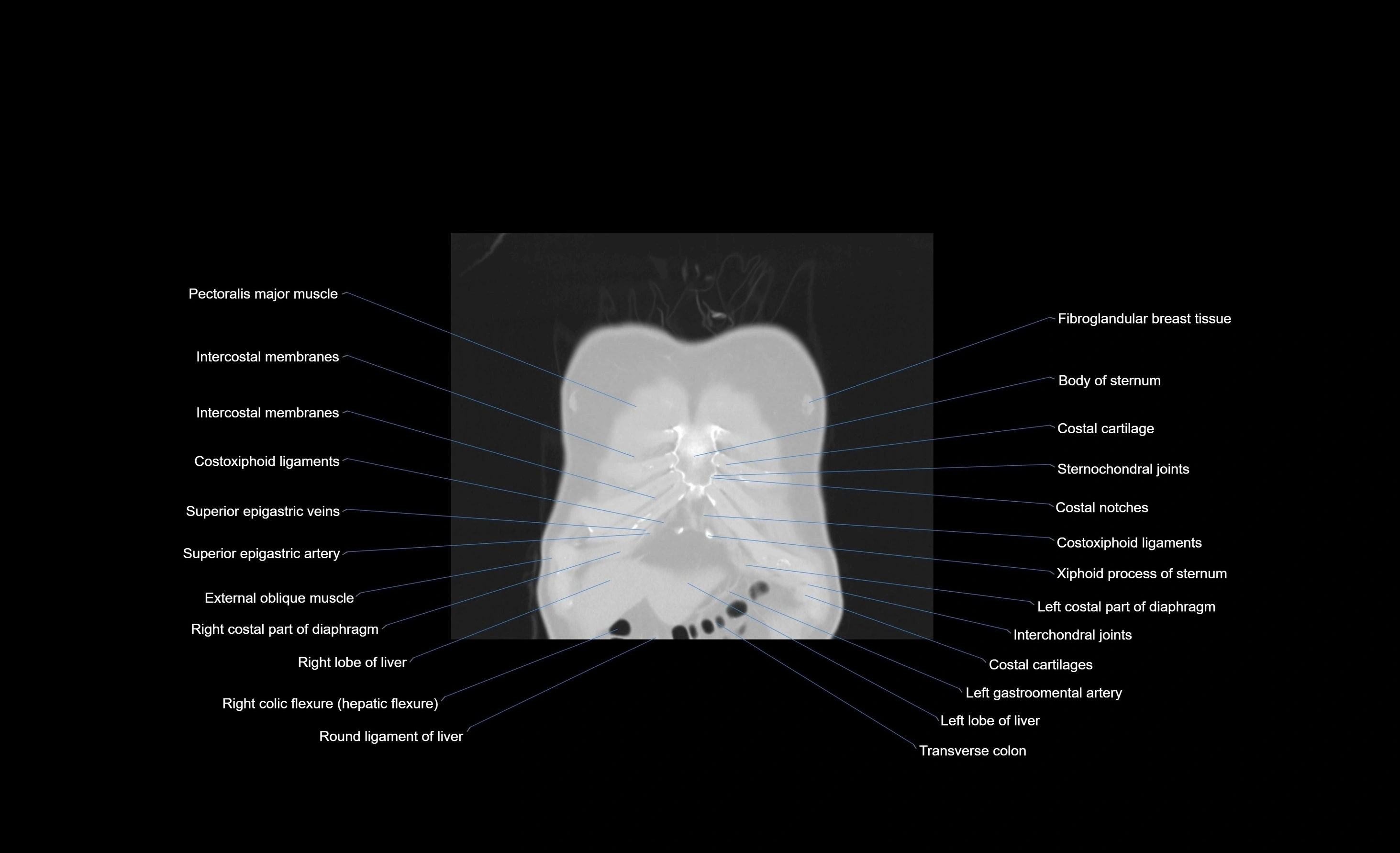 CT chest (thorax) lung window window labelled coronal cross sectional anatomy radiology image-00104.webp